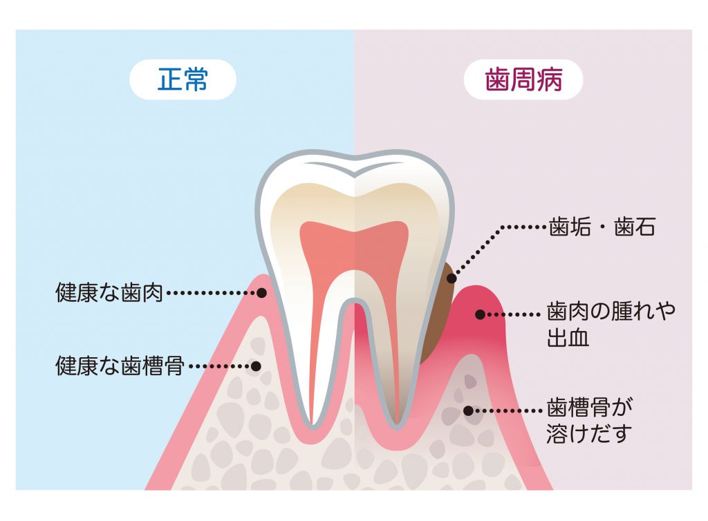 正常な歯と歯周病の歯