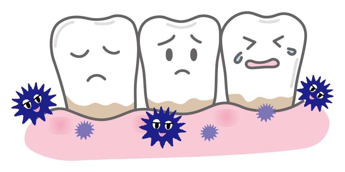歯周病のイメージ